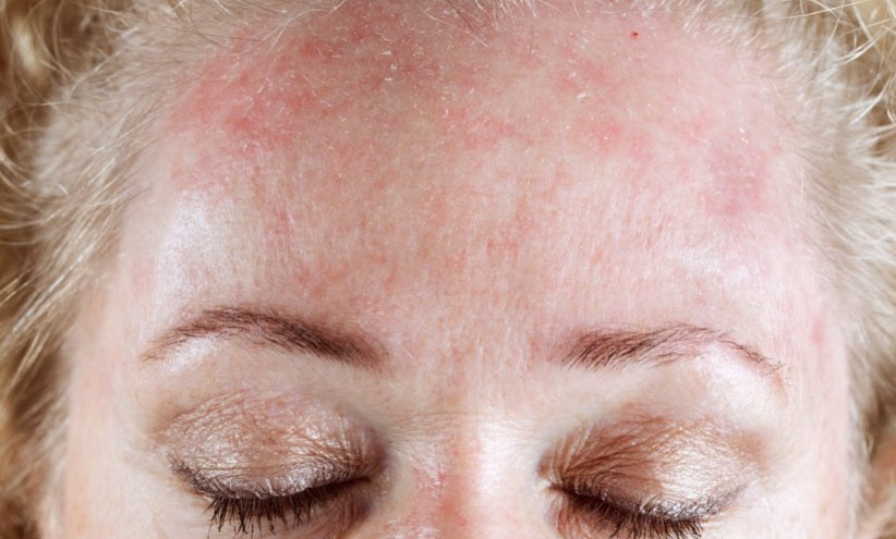 rosacea gezicht verminderen